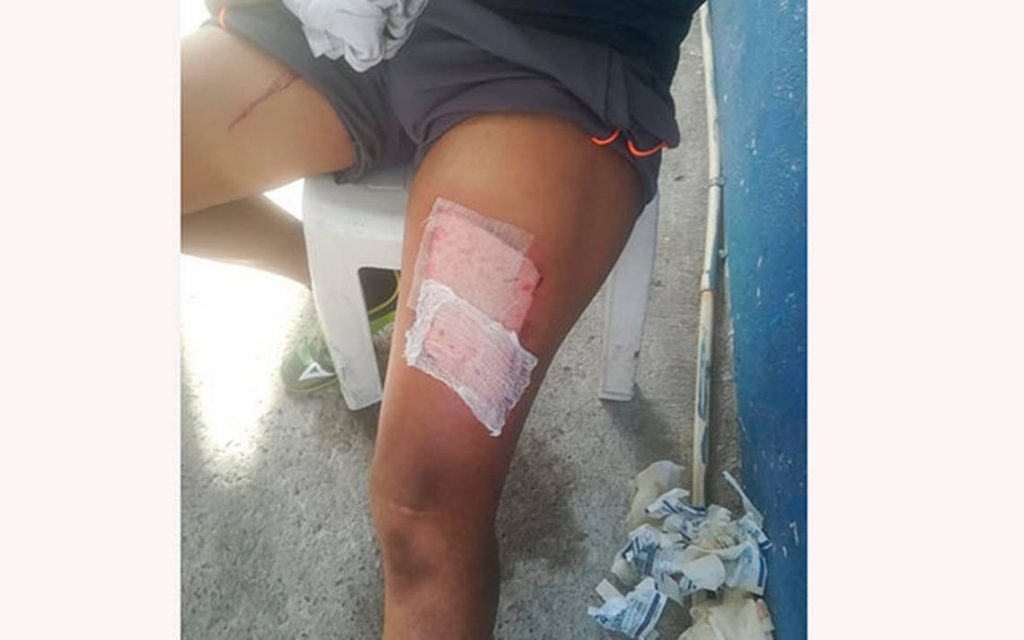 Por infiel, mujer le plancha las piernas a su esposo