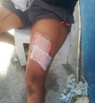 Por infiel, mujer le plancha las piernas a su esposo