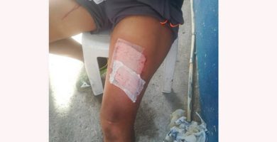Por infiel, mujer le plancha las piernas a su esposo